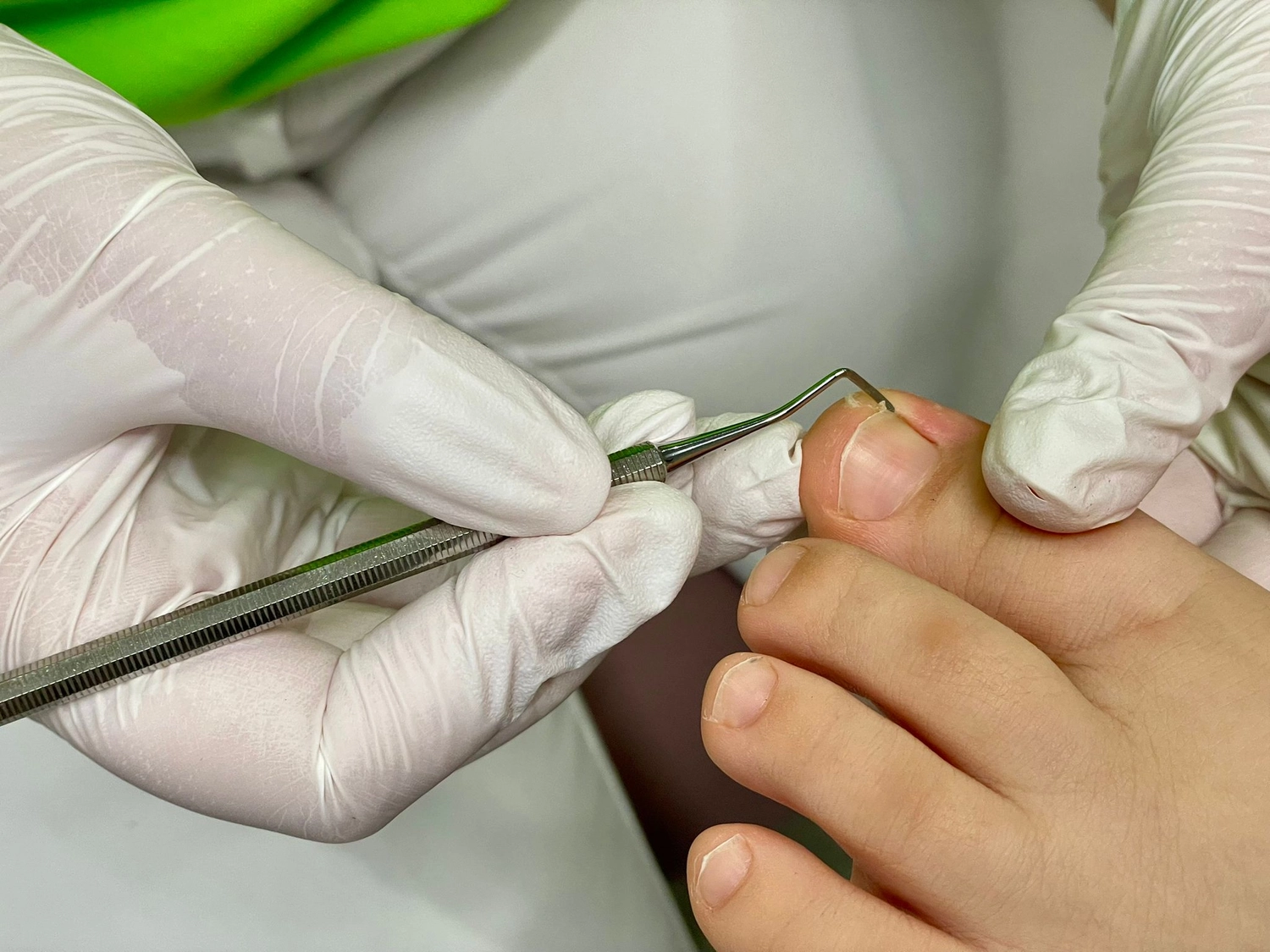 Praxis für Podologie Ramona Herczeg - Medizinische Fußbehandlung - Behandlung eingewachsener Zehennägel 